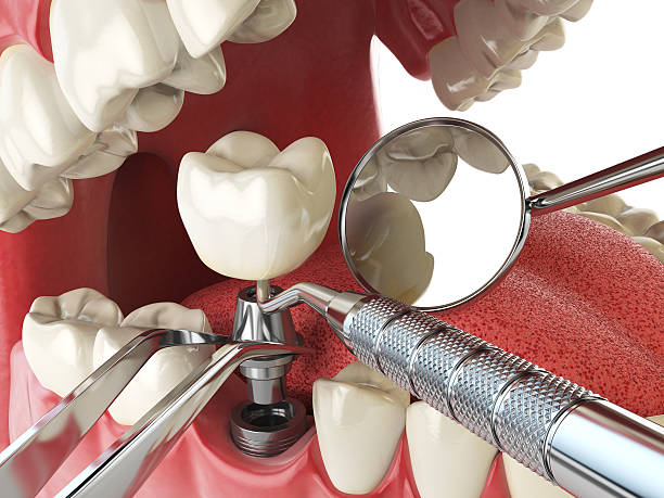 Best Cracked Tooth Emergency Dentist  in Bicknell, IN